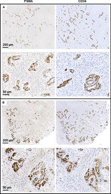 PSMA Expression in Glioblastoma as a Basis for Theranostic Approaches: A Retrospective, Correlational Panel Study Including Immunohistochemistry, Clinical Parameters and PET Imaging